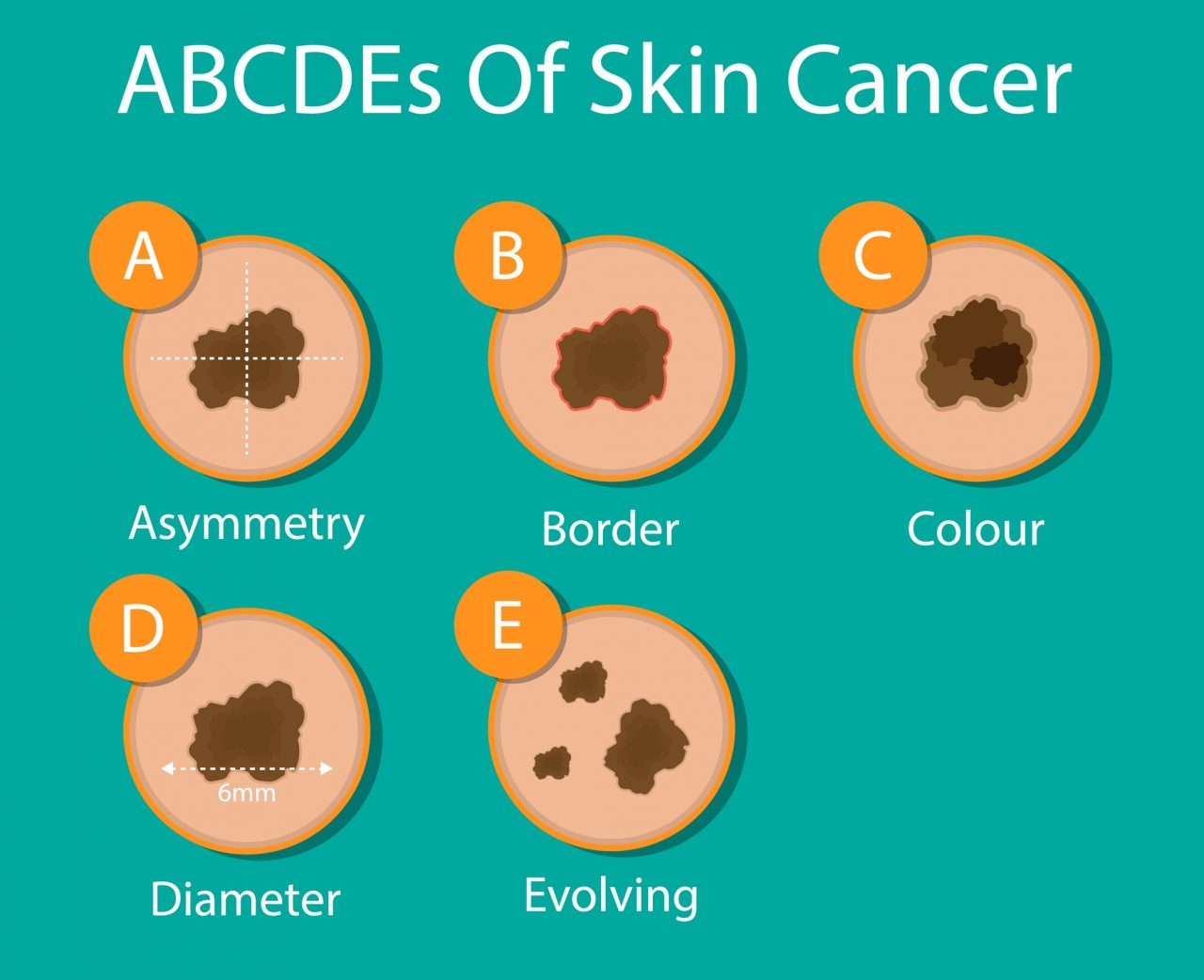 Under the skin: know the signs of skin cancer - The Fire Fighters Charity